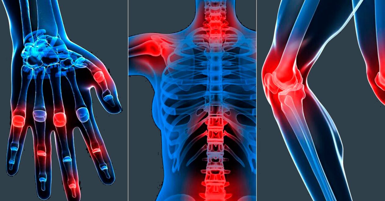 Boswellia ekstraktının kapsüllerde kullanımı için endikasyonlar